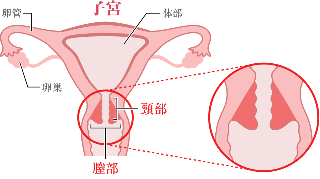 円錐切除